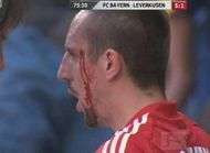 Ribery a une nouvelle cicatrice