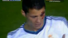 Real : le visage ensanglanté de Cristiano Ronaldo